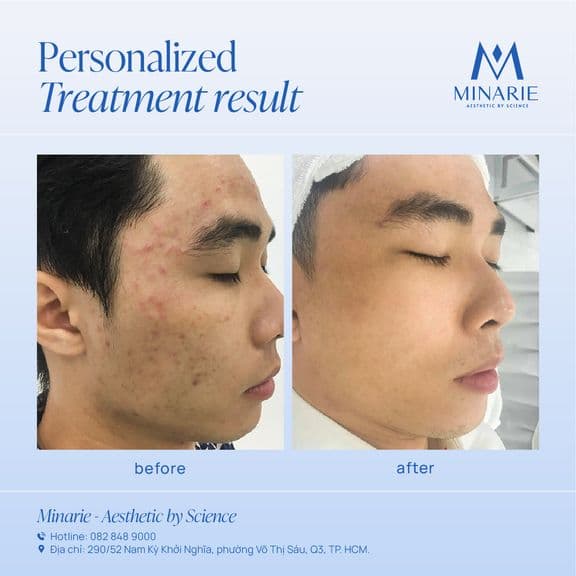 Mụn ẩn - Mụn viêm nặng - Mụn đầu đen - Da sần, sạm - Lỗ chân lông to - Da đổ nhiều dầu - Kết cấu da yếu, nhạy cảm là những vấn đề da mà anh Vinh gặp phải.