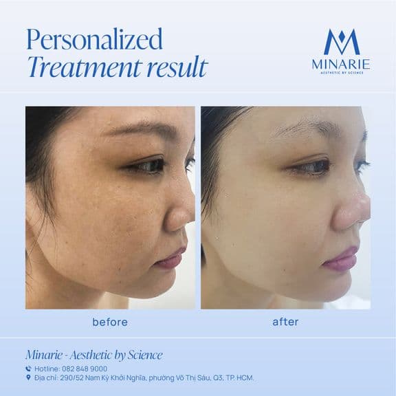 HIỆU QUẢ ĐIỀU TRỊ CHỈ SAU 1 BUỔI ANTI-POLLUTION