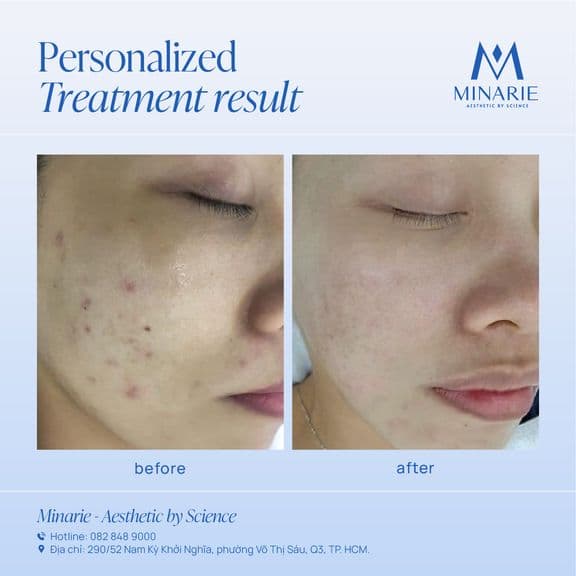 Lâu lâu lại khoe feedback về hiệu quả liệu trình điều trị mụn cá nhân hoá để tiếp thêm động lực cho các nàng đang chiến đấu với mụn nè.