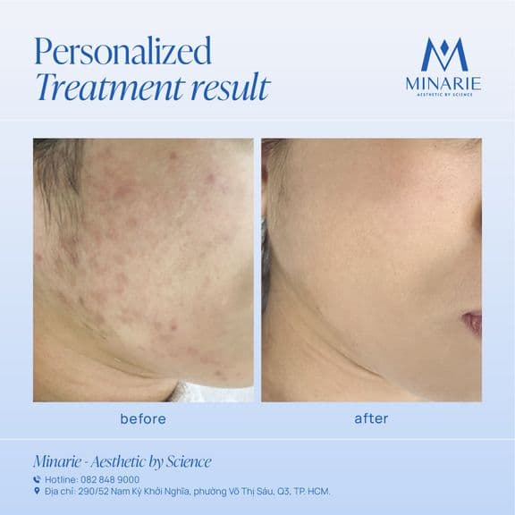 KẾT QUẢ ĐIỀU TRỊ LÀN DA BỊ TỔN THƯƠNG DO LẤY NHÂN MỤN SAI CÁCH